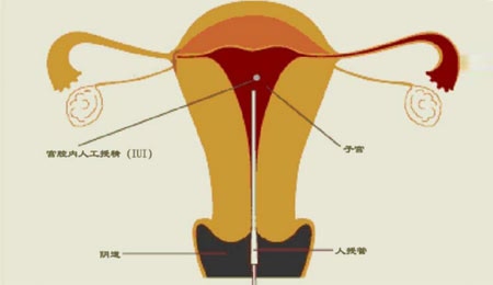 海口做试管婴儿